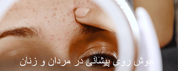 علت جوش پیشانی در زنان